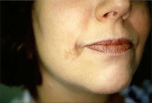 Tanda Lahir Café au Lait